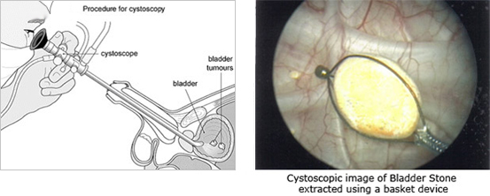 cystoscopy