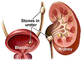 Kidney Stones - Nephrolithiasis